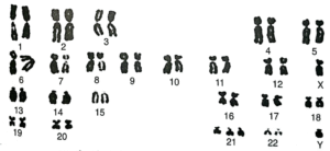 Chromosomes of a male with Down's Syndrome
